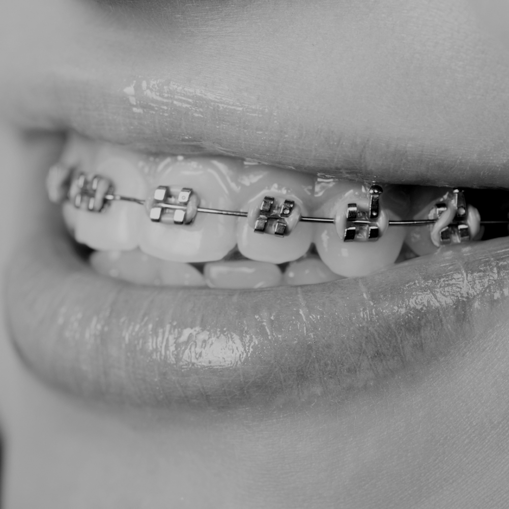 Fixed Braces - Macclesfield Orthodontics